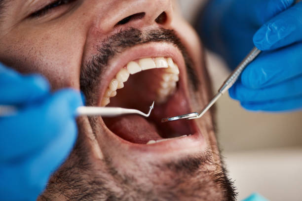Best Knocked-Out Tooth Emergency  in Gloster, MS
