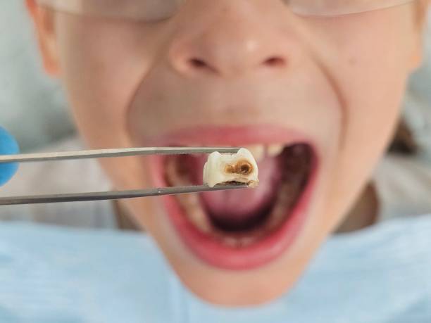 Best Root Canal Emergency Dentist  in Gloster, MS